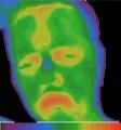 Tumor hipofize